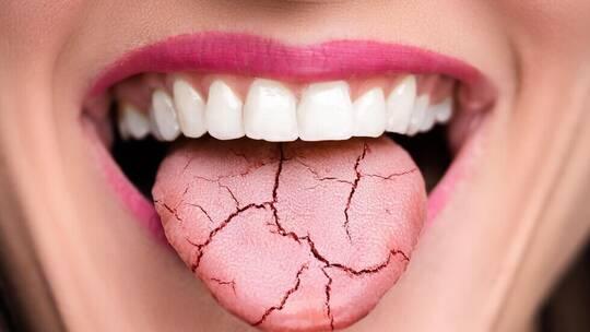 جفاف الفم قد يكون عارضا لخمسة أمراض خطرة