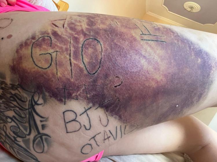 Mulher torturada e tatuada à força pelo ex inicia remoção das marcas: 'Na minha cabeça, eu já estava morta'