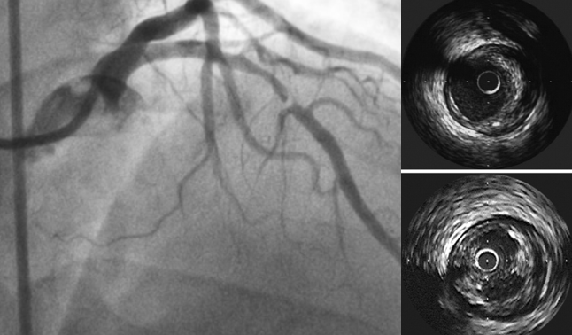 IVUS-CHIP trial negativo? Il significato dell’IVUS nell’angioplastica complessa contemporanea