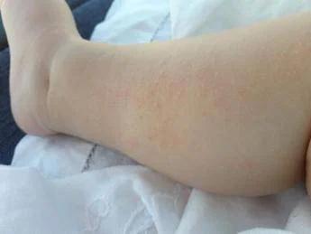 Dermatite atopica, Aifa estende rimborso di upadacitinib dai 12 anni di età