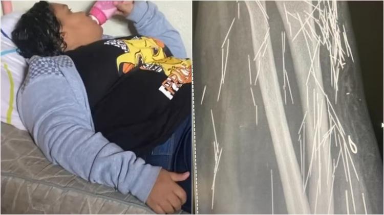 Mulher de 37 anos que fingiu ter 12 denunciou a própria família por abusos sexuais e por colocar agulhas no corpo dela há 16 anos