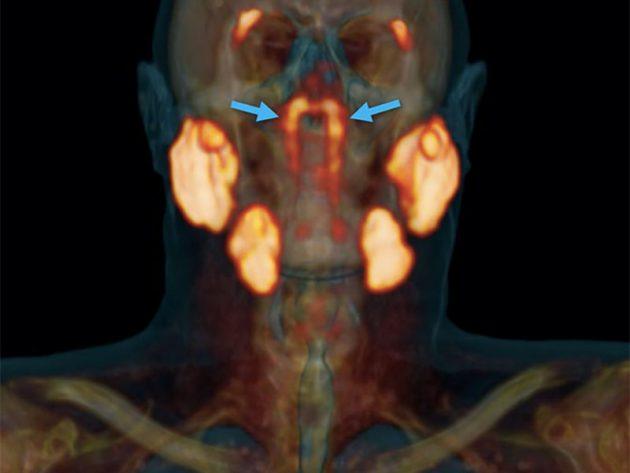 Mit einem neuen Scan-Verfahren entdeckten niederländischen Mediziner zwei bislang unbekannte Speicheldrüsen hinter dem Nasenrachen. Copyright/Quelle: Valstar et al., Radiotherapy and Oncology, 2020