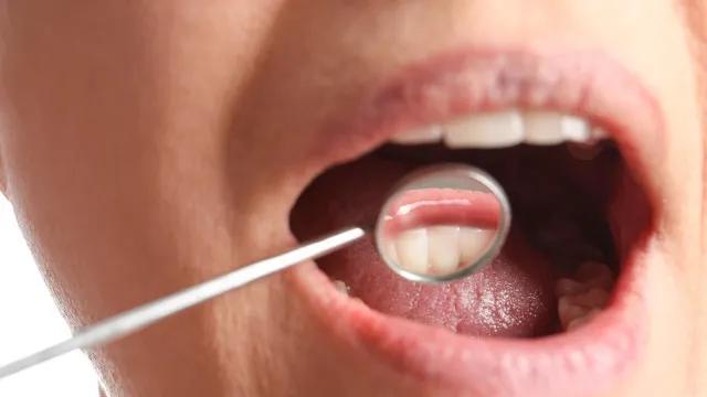 Acúmulo de tártaro: o que faz algumas pessoas terem mais do que outras?