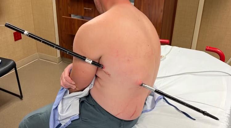 Enfermeiro sofre acidente em trilha e caminha 16 km com bastão atravessado no corpo nos EUA