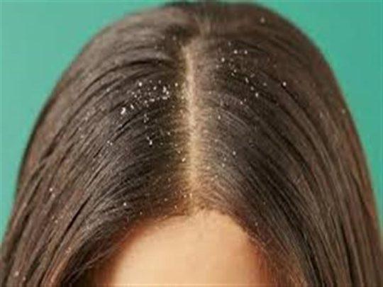 وصفات منزلية فعالة للتخلص من قشرة الشعر بصفة نهائية