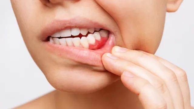 Retração gengival: por que a gengiva se afasta dos dentes e como prevenir
