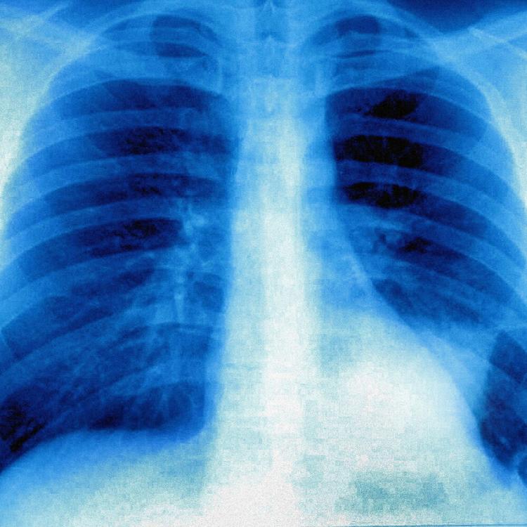 Il tumore al polmone si scopre con il test del respiro