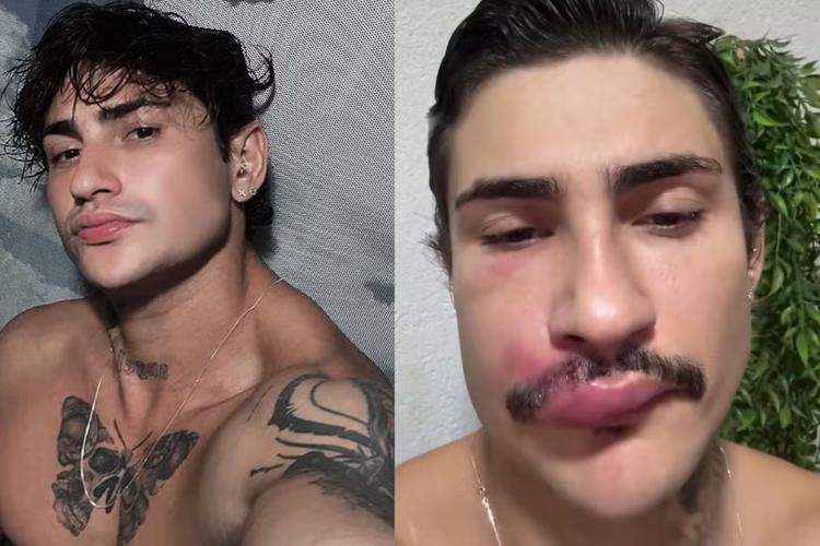 'Ken de CG': influencer é internado com infecção após espremer espinha na boca