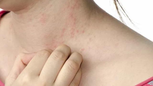 Sarna humana: como identificar e tratar a doença que suspendeu aulas em escola de Atibaia