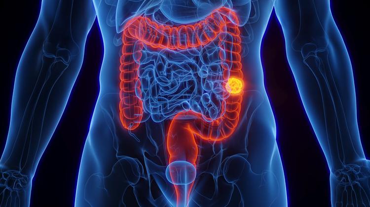 Quase 70% dos brasileiros não conhecem exame que pode identificar câncer de intestino; saiba os fatores de risco