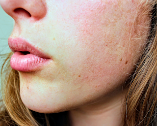 SOS Pelle Secca: Quali Ingredienti Skincare Preferire