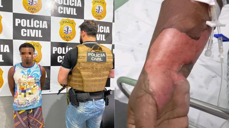 Homem é preso suspeito de atear fogo na ex-companheira em tentativa de feminicídio no MA