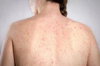 Morbillo, l'allarme dell'infettivologo Andreoni: "Casi in crescita, ricoveri frequenti negli adulti"