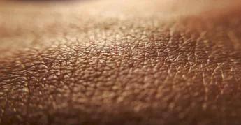 Dermatite atopica, quando la pelle condiziona la vita, 'Diari atipici' dà voce ai pazienti