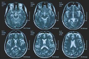 Tumori, glioma pediatrico di basso grado: via libera in Europa a prima terapia mirata