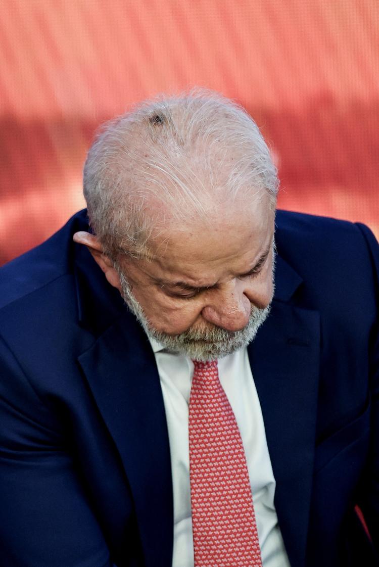 Lula fará retirada de queratose na cabeça e infiltração no punho hoje; entenda os procedimentos