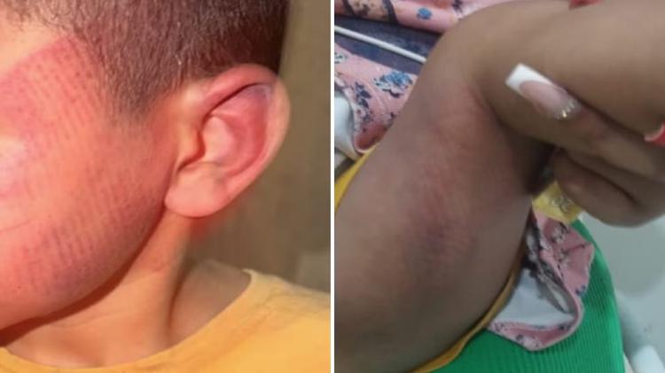Mulher diz que namorado espancou e deixou marcas de chinelada nos filhos do casal por não aceitar término: 'Nunca imaginei que ele fosse capaz'
