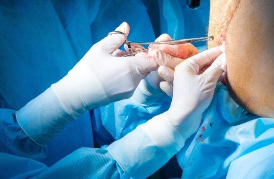 Botox para Fisuras Anales Precio
