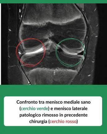 Tornare a camminare con un trapianto: a 12 anni riceve un menisco da donatore deceduto, intervento in artroscopia a Treviglio (Bg)