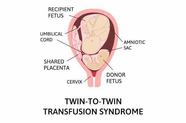 Sindrome da trasfusione feto-fetale - TTTS